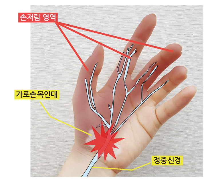 손목터널증후군 치료법 손목에 통증이 있고 저려요